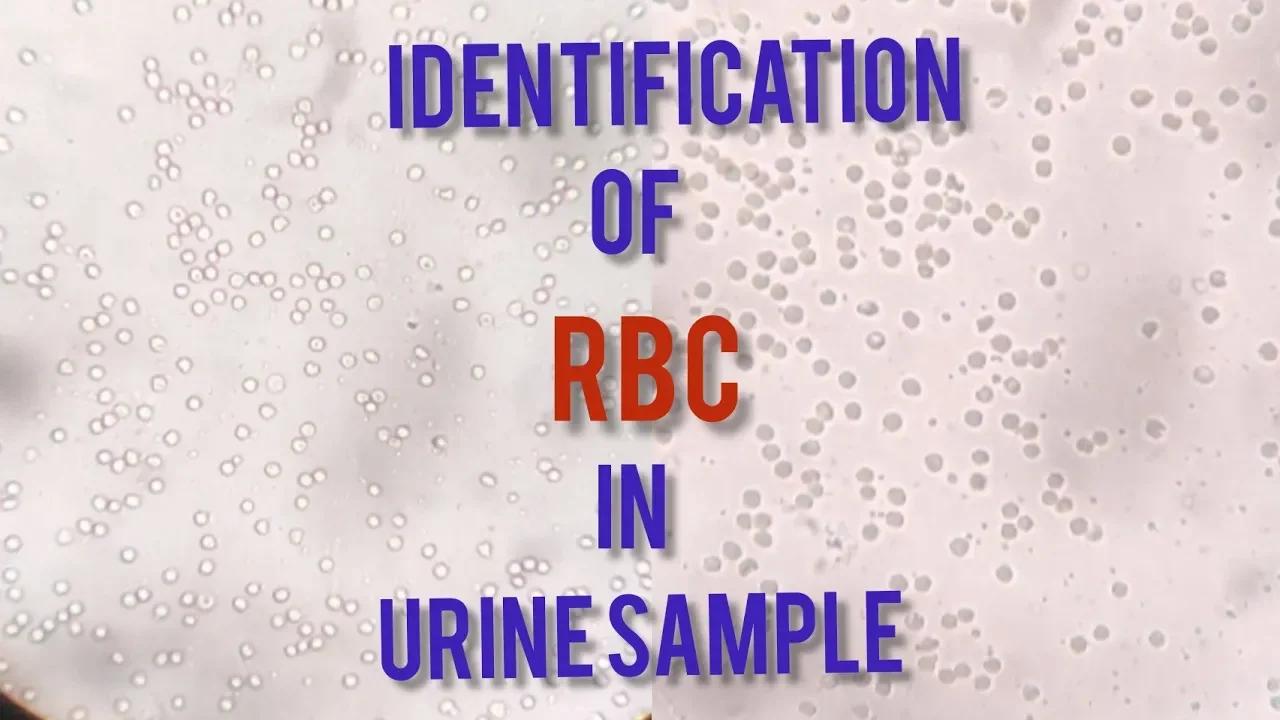 How To Identify RBC In Urine || How To Report RBC Count in Urine Sample