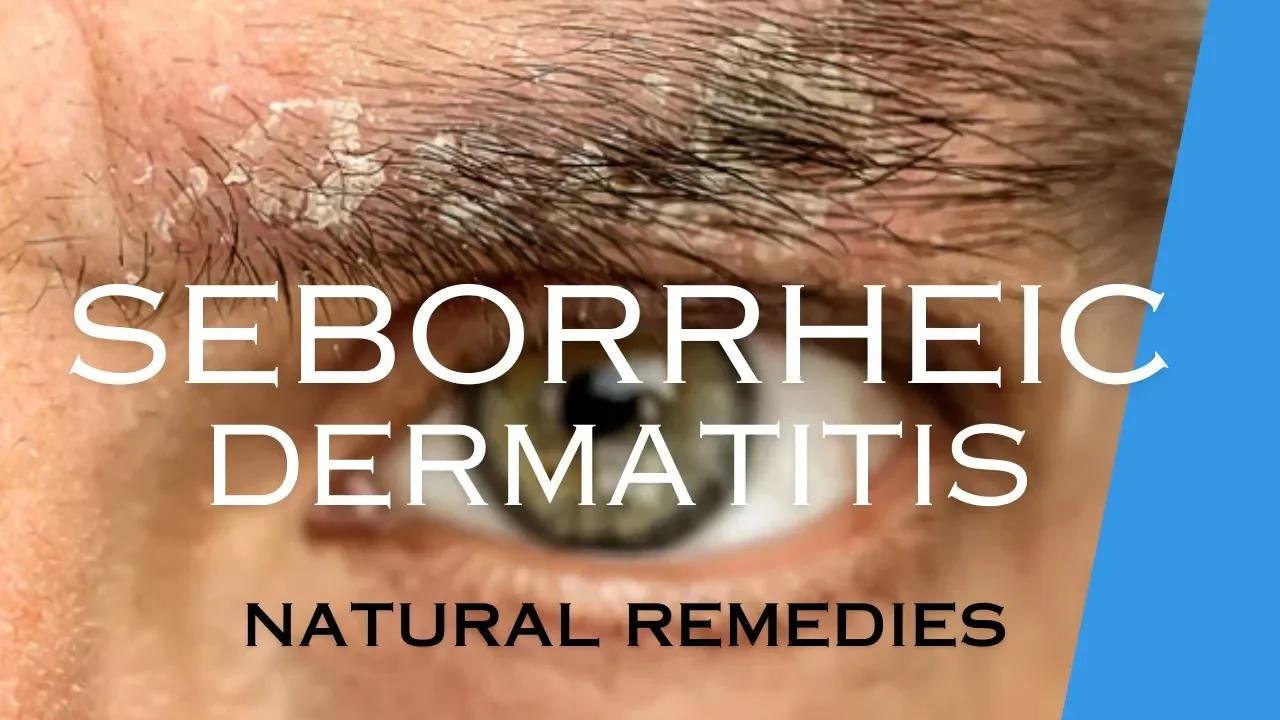 treat-seborrheic-dermatitis-with-natural-remedies