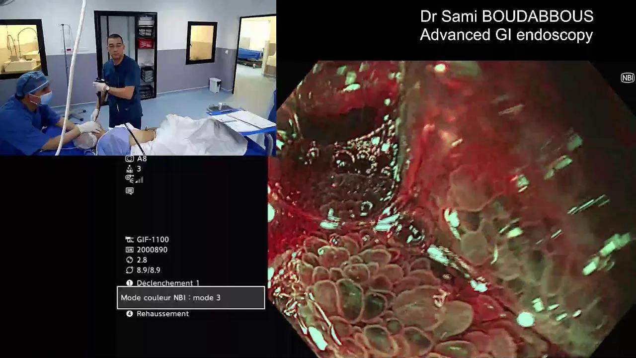 large duodenal ulcer oin CT scan