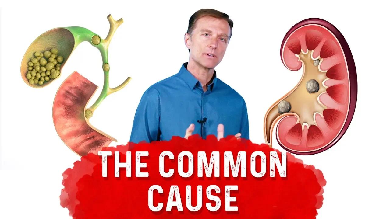 Gallstones vs Kidney Stones A Common Cause