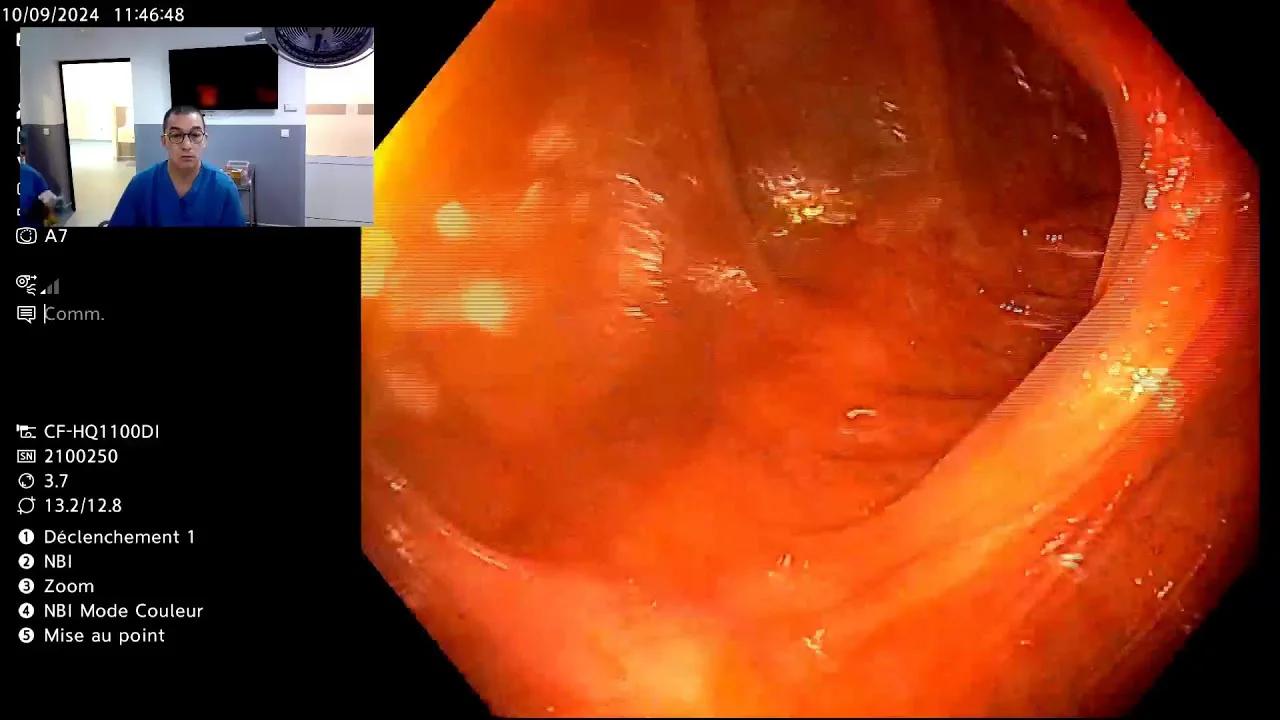 Rectal bleeding