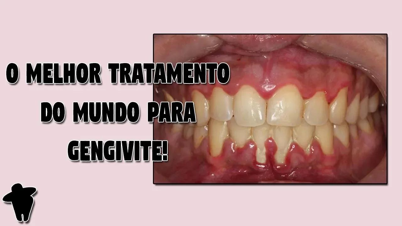 Gengiva Inflamada e Sangrando? DESCUBRA Qual o Melhor Tratamento ...