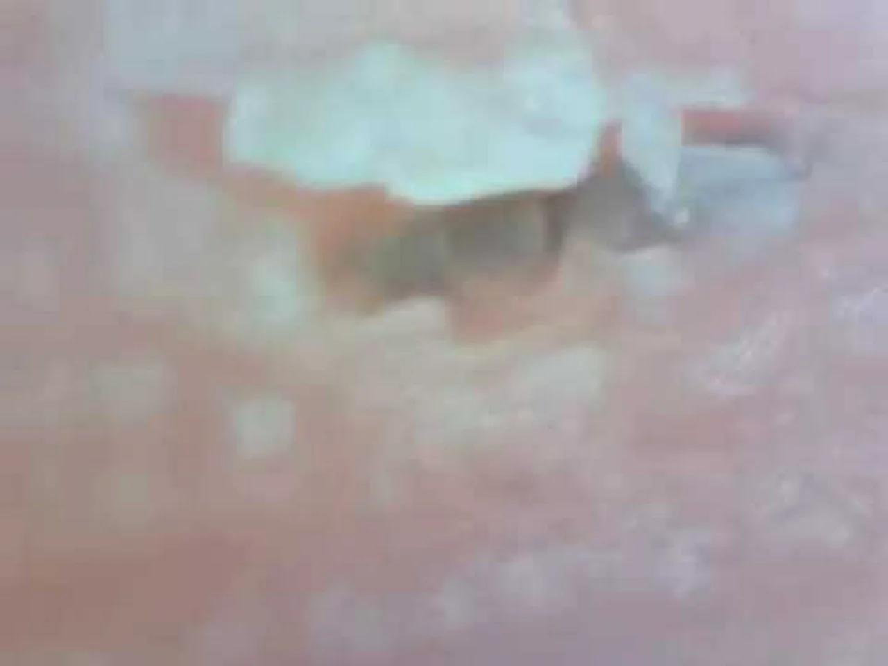 Splinter under a microscope with Hydrogen Peroxide
