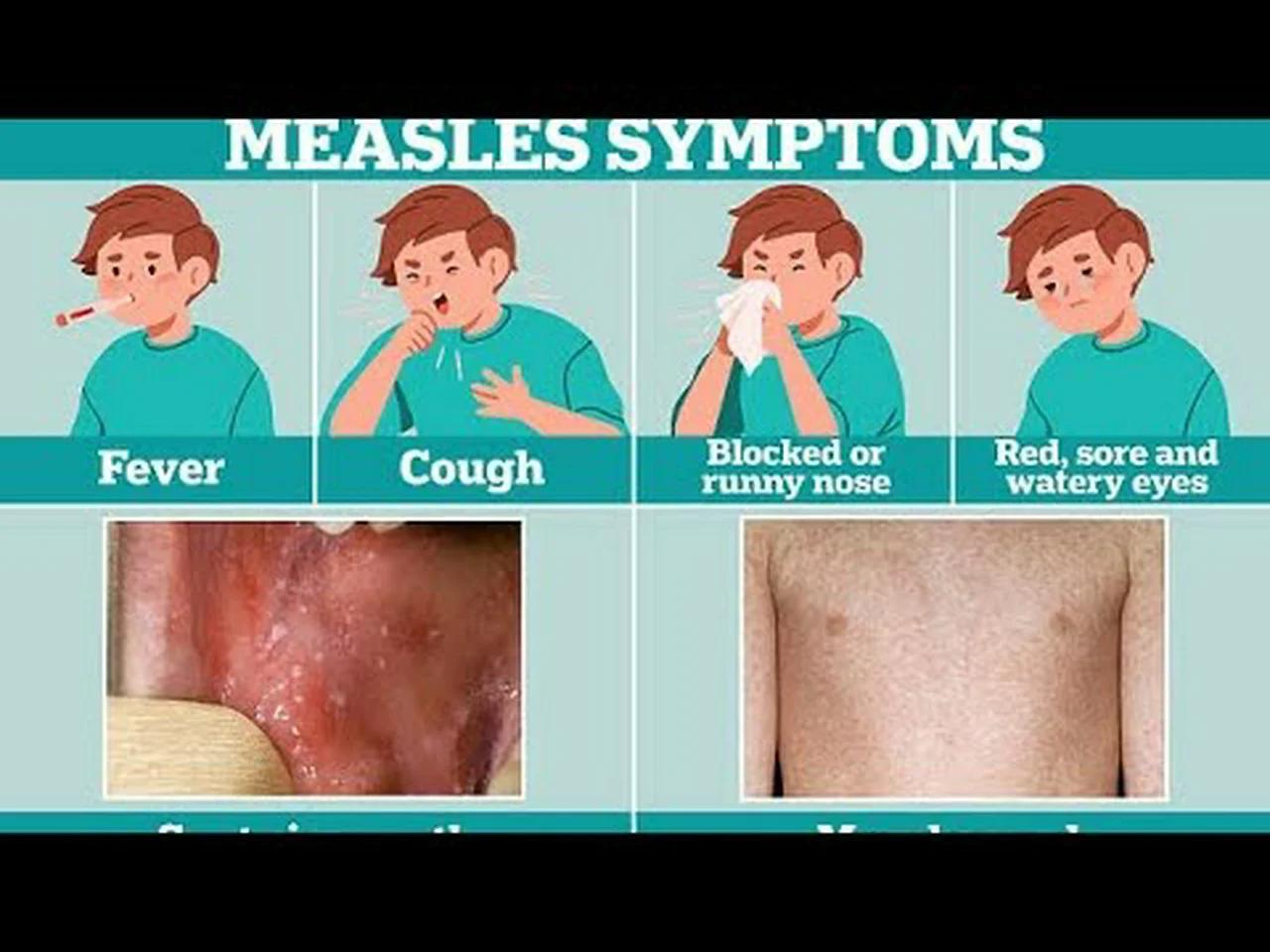 Measles Signs And Symptoms Complications Prevention
