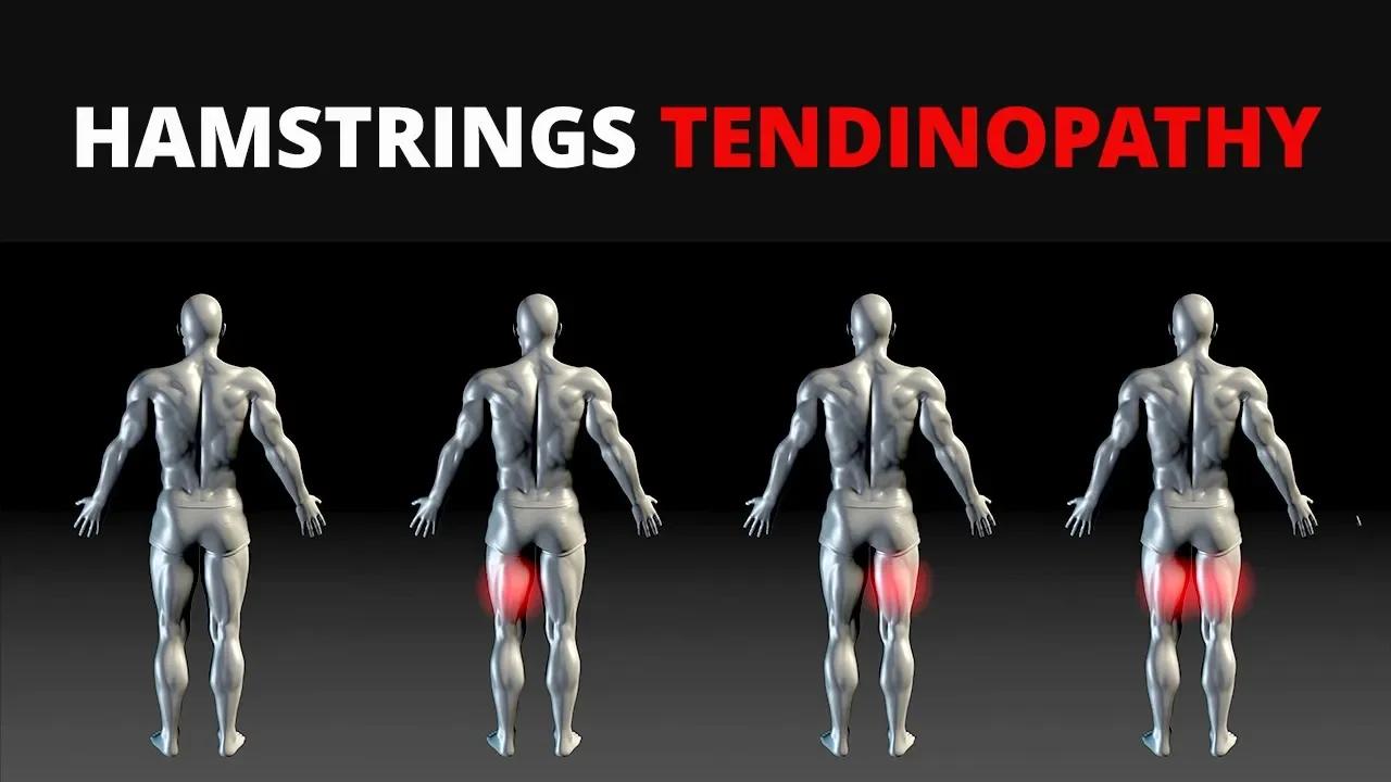 Proximal Hamstring Tendinopathy FULL Exercise Plan (Causes and Relief ...