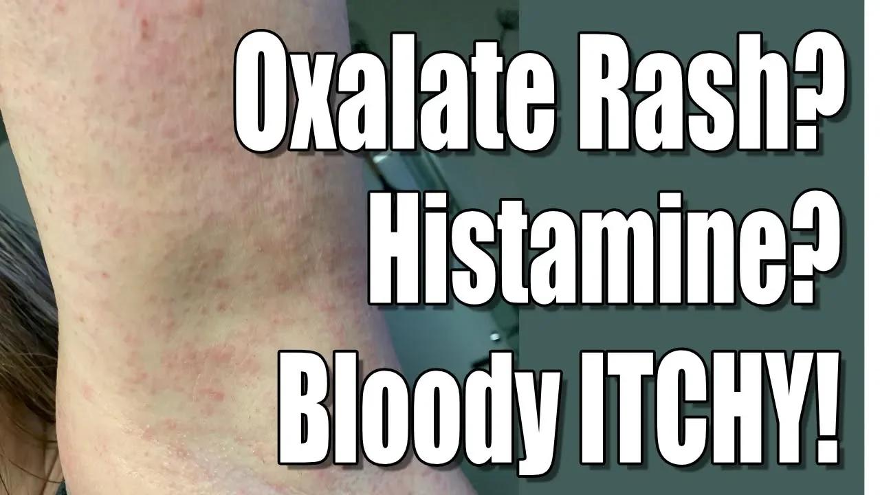 Oxalate Dumping Skin Rash? Histamine? Connections Between Oxalate ...