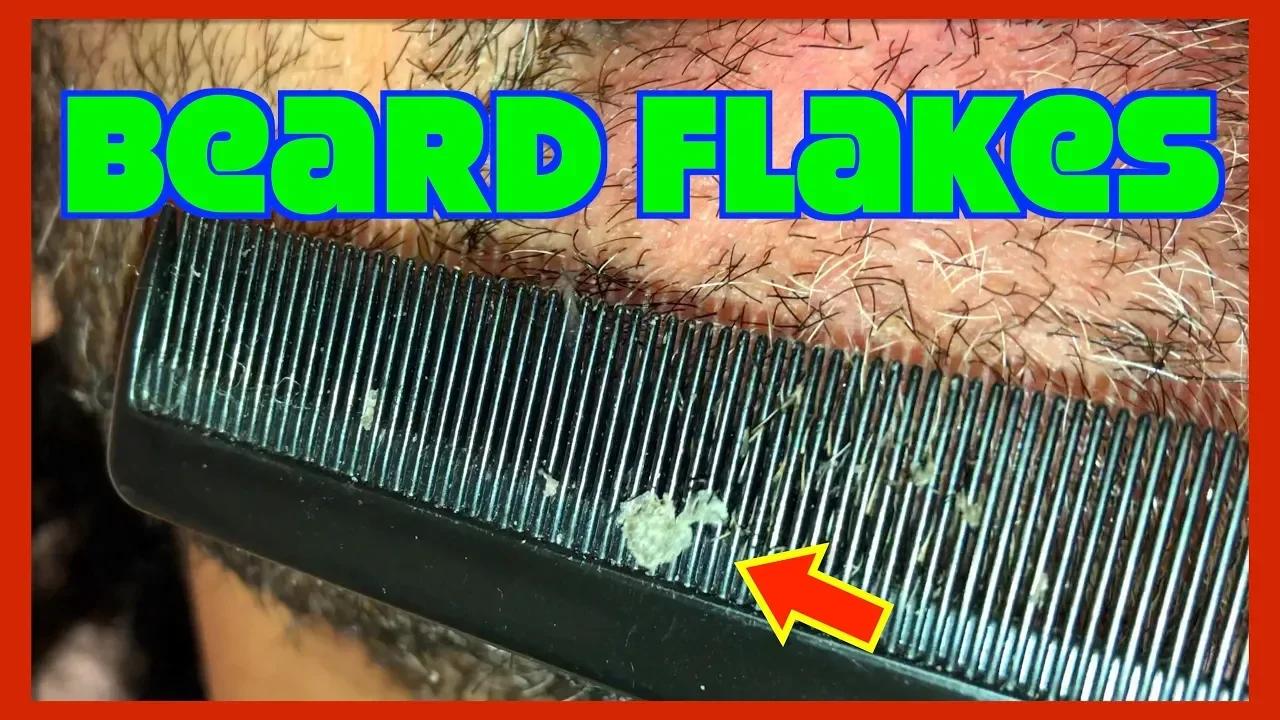 Face full of flakes | Beard dandruff | PitaFlakes