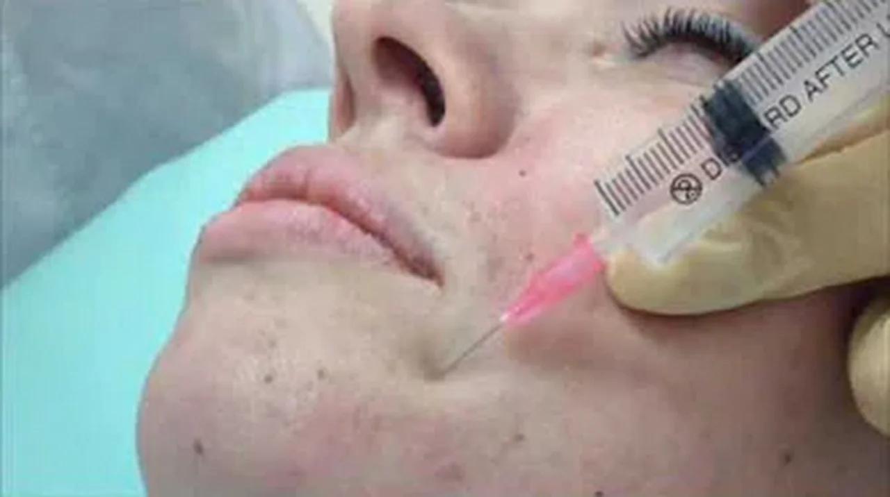 Ozone injection into wrinkles