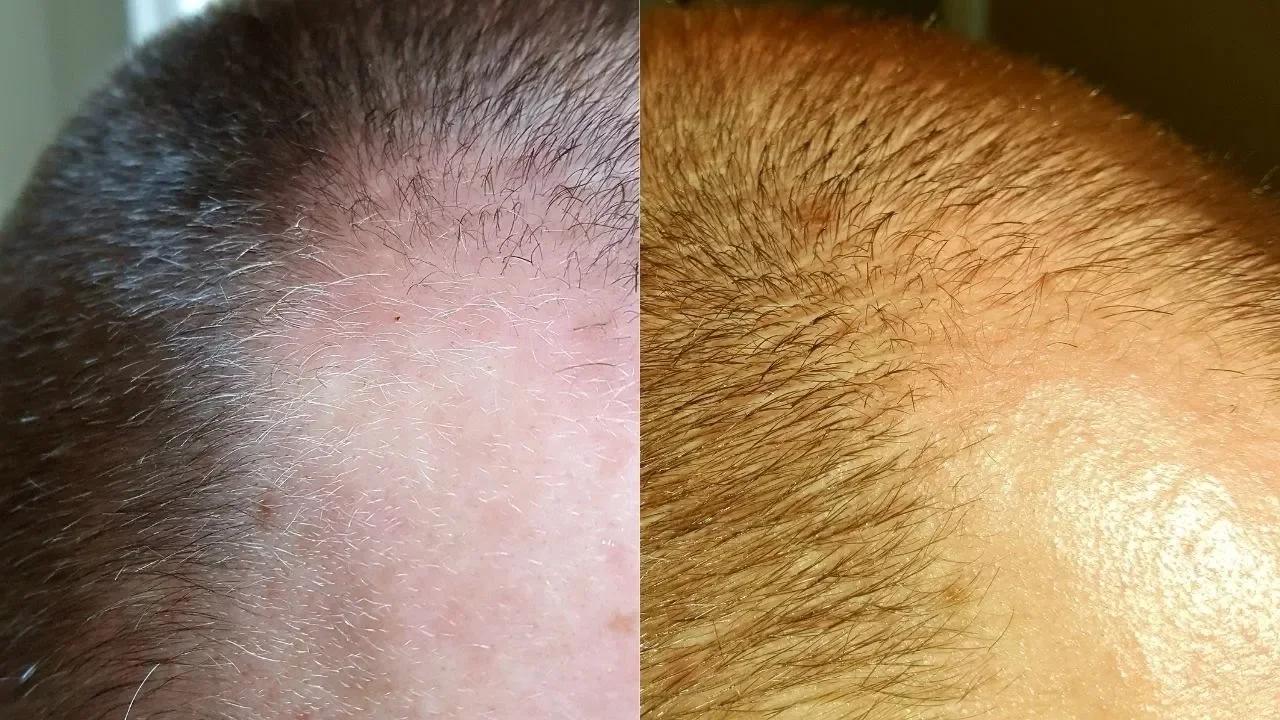 Comparing the Two Treatments