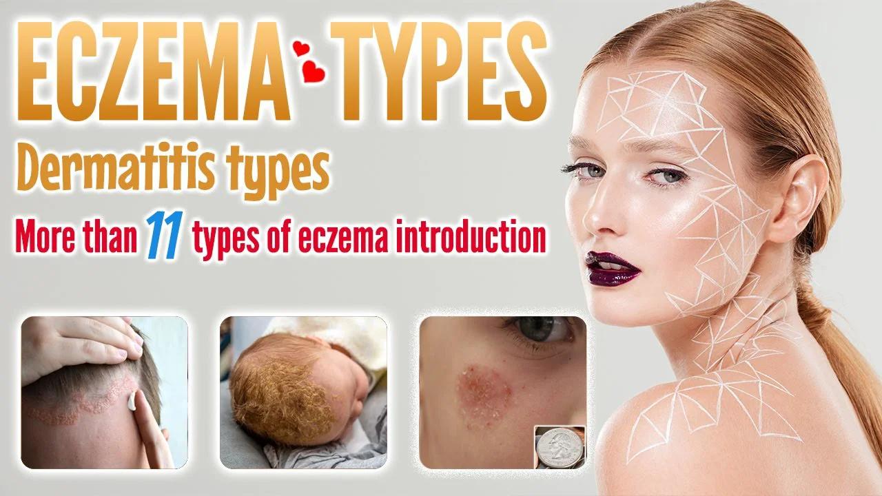 Eczema types with picture | More than 11 dermatitis (eczema) types you ...