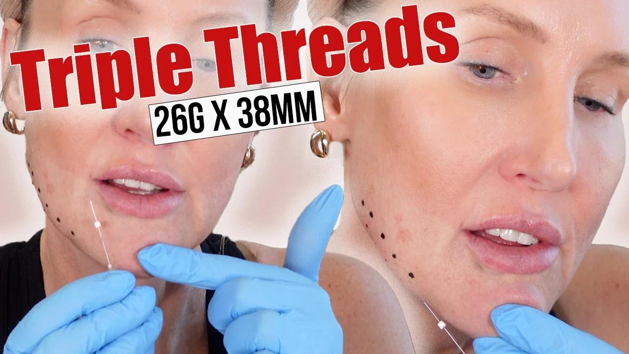 Triple Threads for Jawline & Marionette Lines - Lift & Volume Restoration