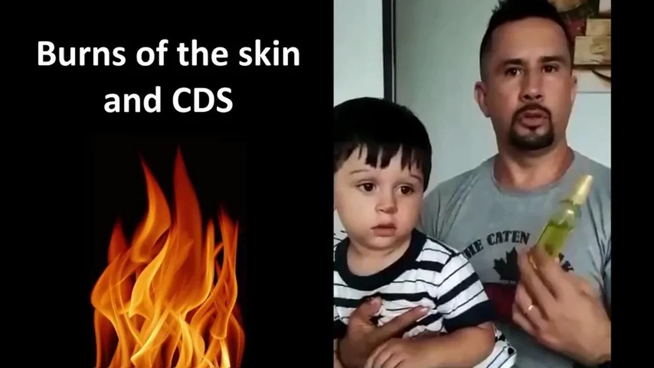 Skin Burns and CDS, Chlorine Dioxide Solution. Testimonial of a father.