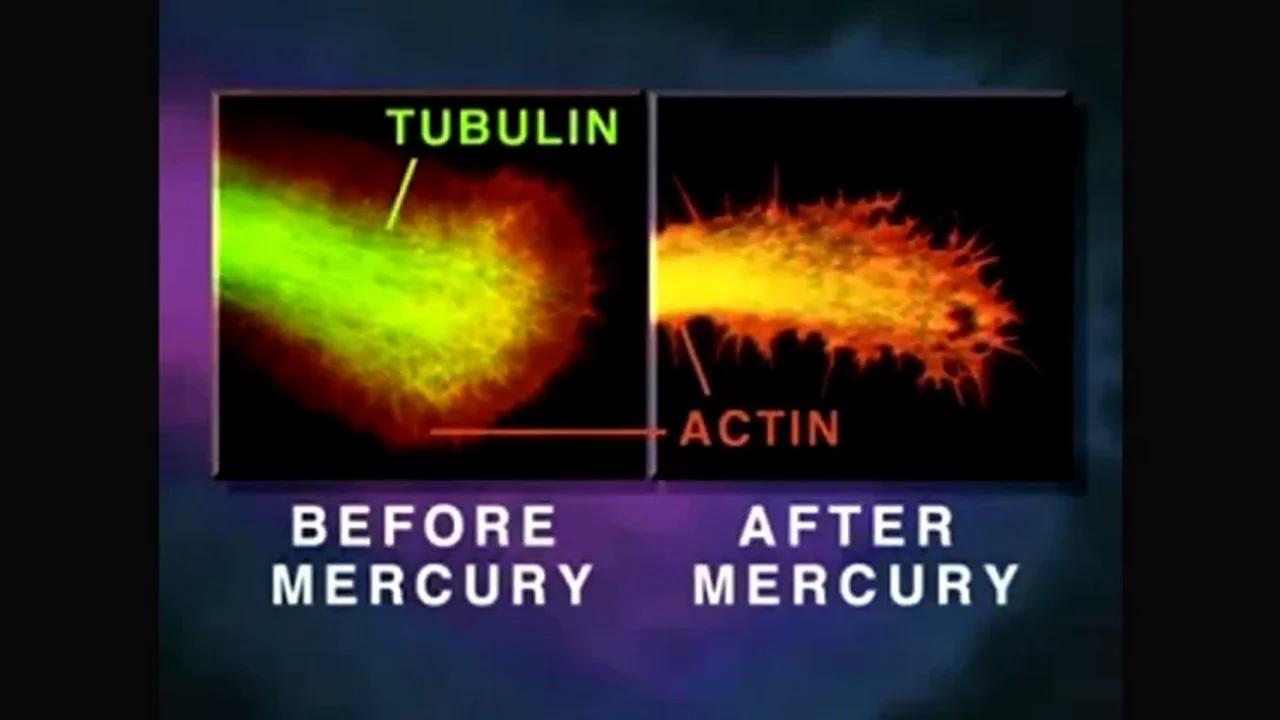 Amalgam Mercury Fillings, Vaccines And Neurodegeneration Watch Mercury