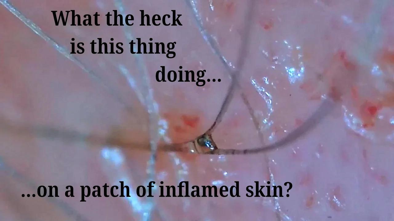 Biotechnological Invasion of Skin - Analysis & Overview