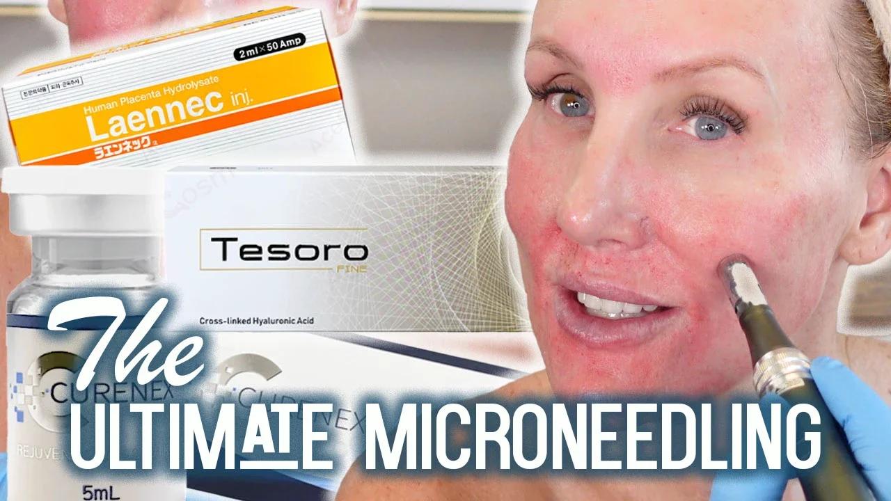 Deep Microneedling on Face + Neck + Chest - PRO TUTORIAL